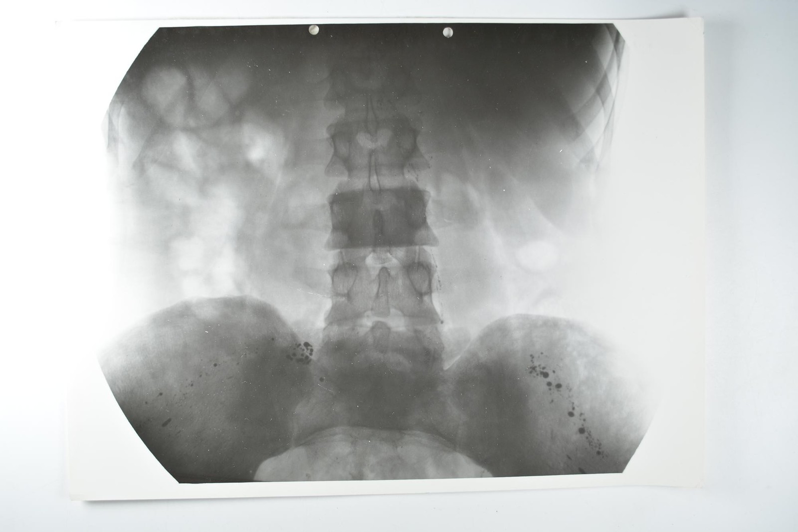 Medical X-Ray Spine Pelvis Dr Ledoux-Lebard Paris Osteite L3 c1930s VTG Photo