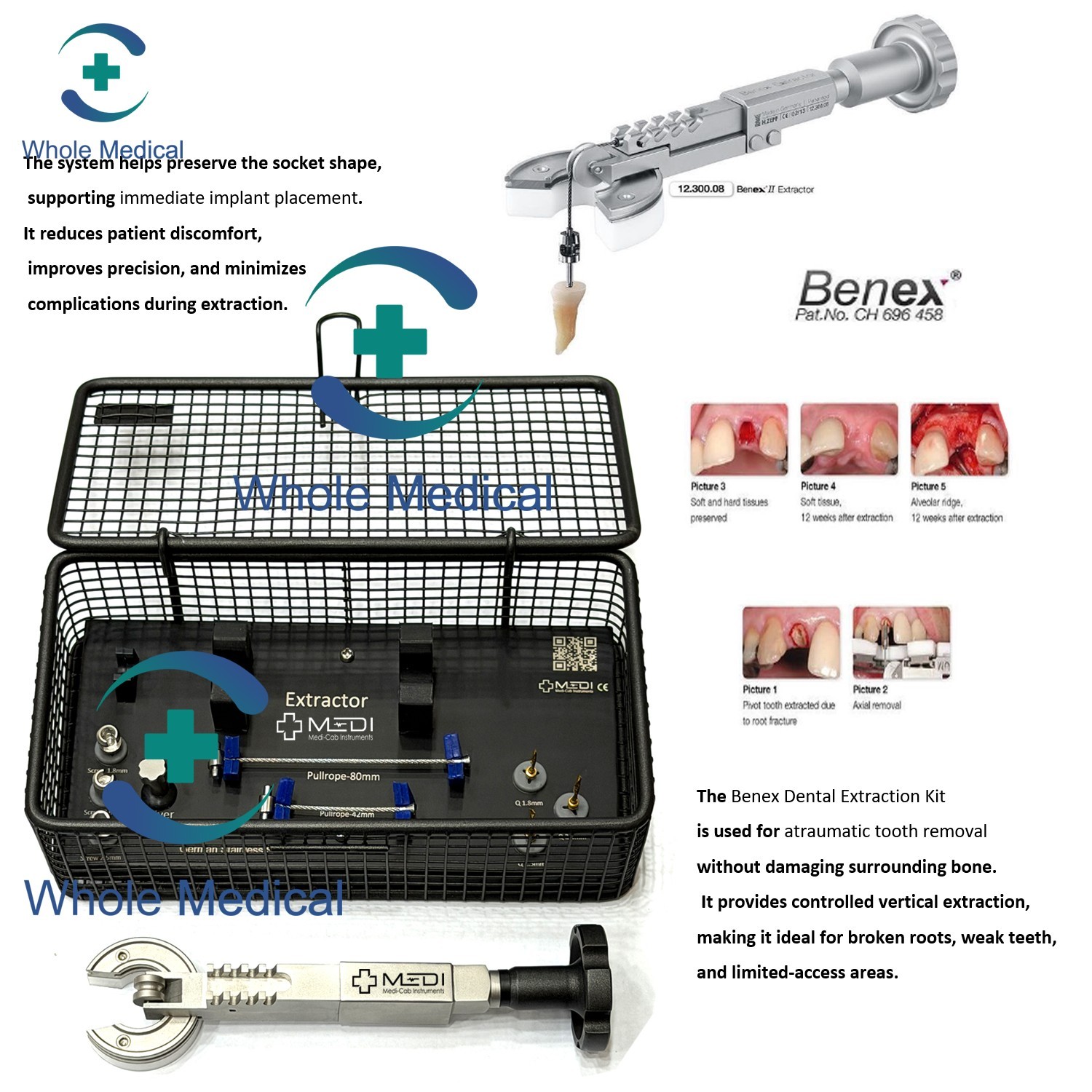 BENEX Extraction System Full Kit for Atraumatic Tooth Removal Dental Instrumet BENEX Extraction System Full Kit for Atraumatic Tooth Removal Dental Instrumet