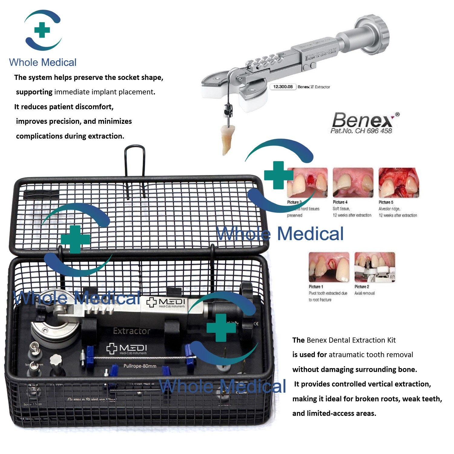 BENEX II Tooth Extraction System For DENTAL Practices High Quality Complete SET