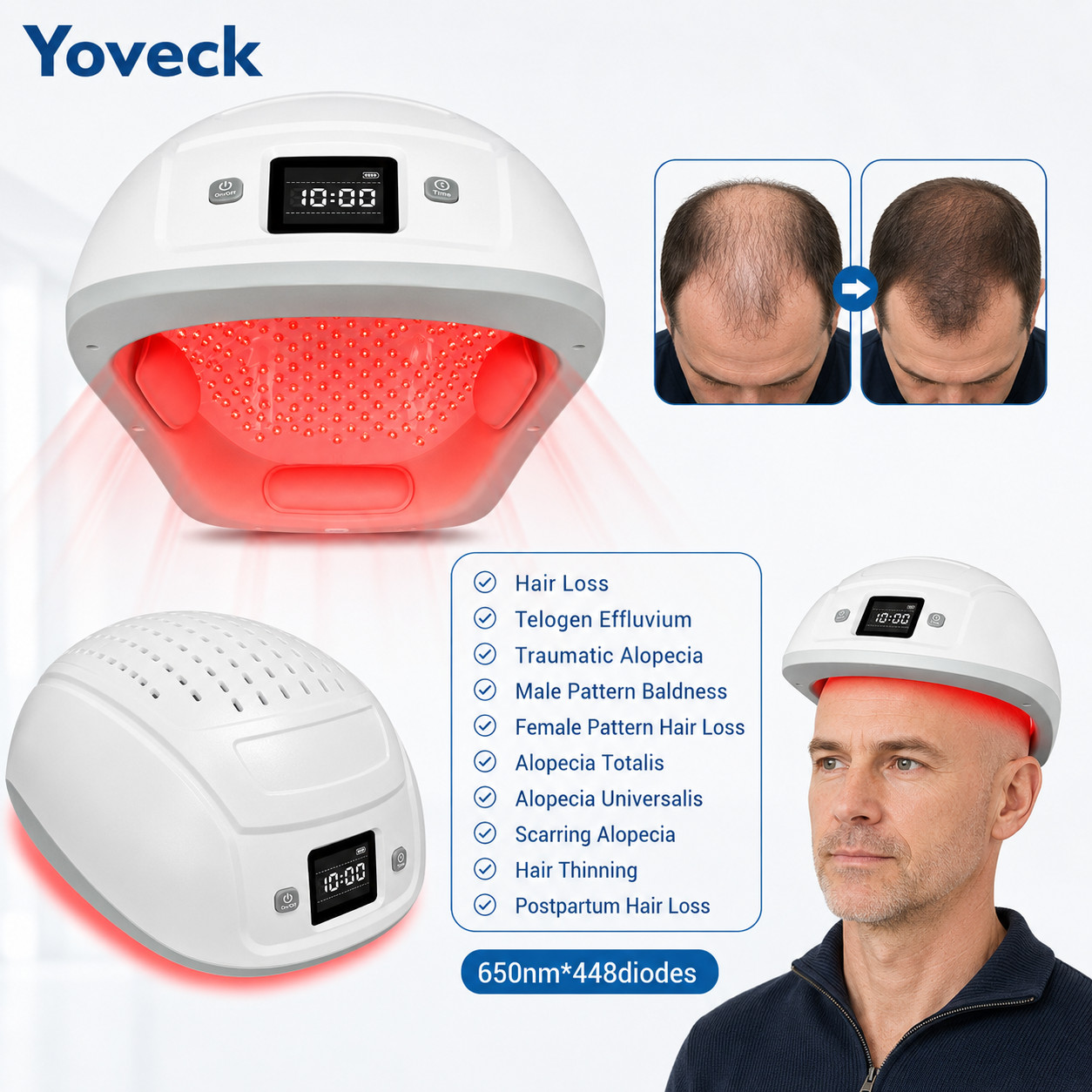 448 Diodes 650nm Laser Cap for Hair Growth Thinning Hair Telogen Effluvium Care