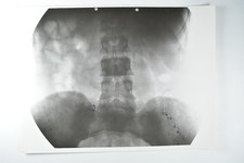 Medical X-Ray Spine Pelvis Dr Ledoux-Lebard Paris Osteite L3 c1930s VTG Photo picture