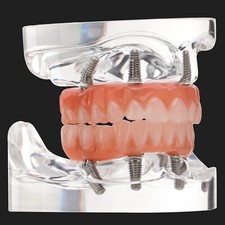 Dental Implant All-on-4 Overdenture Treatment Model Upper/Lower 4 Implants Clear picture