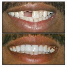 Tooth Fairy RenewaSmile Temporary Tooth Replacement Kit –Make 25 Teeth Fast Safe picture