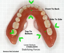 Lower Denture Stabilizers DIY Kit-Affordable Denture Stabilization  picture